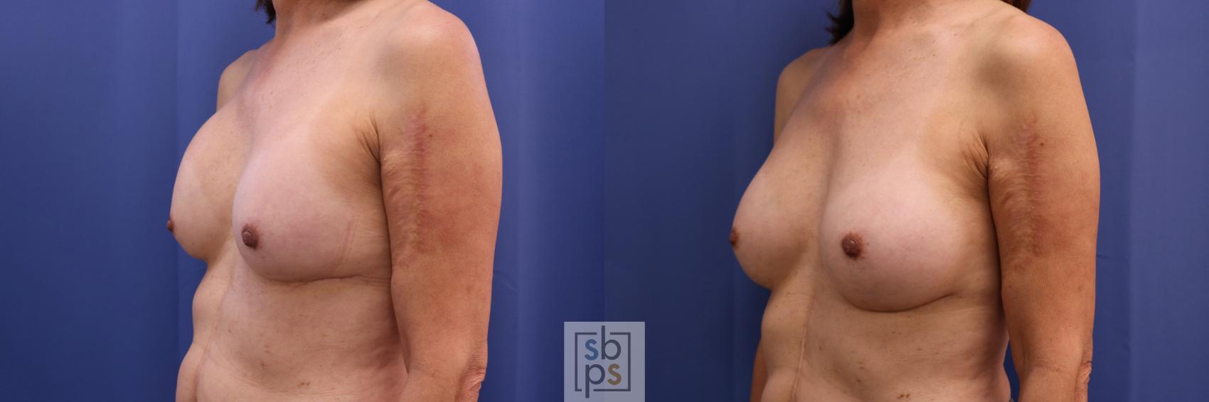 Before & After Breast Augmentation Case 325 View #3 View in Torrance & Los Angeles, CA, CA