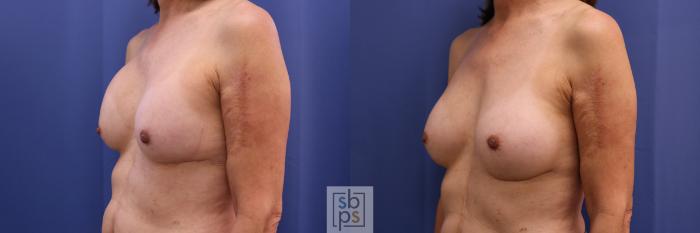 Before & After Breast Augmentation Case 325 View #3 View in Torrance, CA