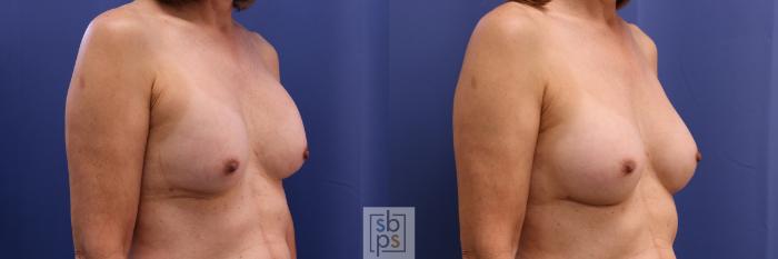 Before & After Breast Augmentation Case 325 View #5 View in Torrance, CA