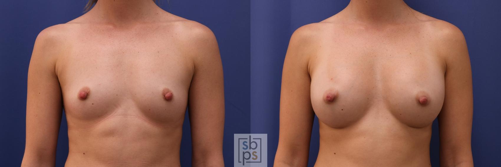 Before & After Breast Augmentation Case 326 View #1 View in Torrance, CA