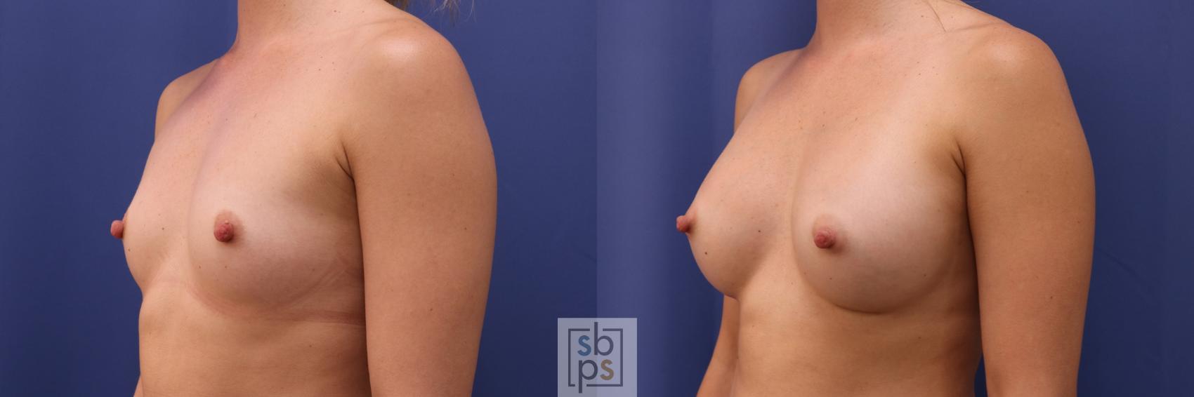Before & After Breast Augmentation Case 326 View #3 View in Torrance & Los Angeles, CA, CA