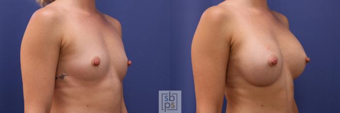 Before & After Breast Augmentation Case 326 View #5 View in Torrance, CA