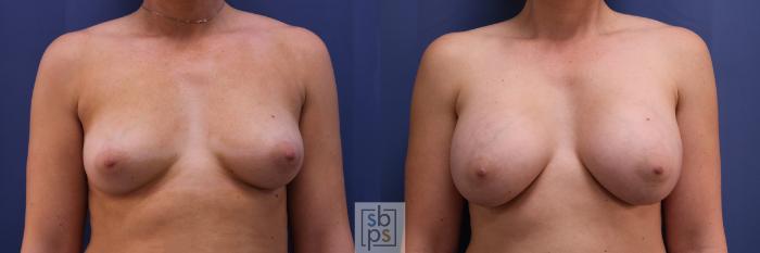 Before & After Breast Augmentation Case 327 View #1 View in Torrance, CA