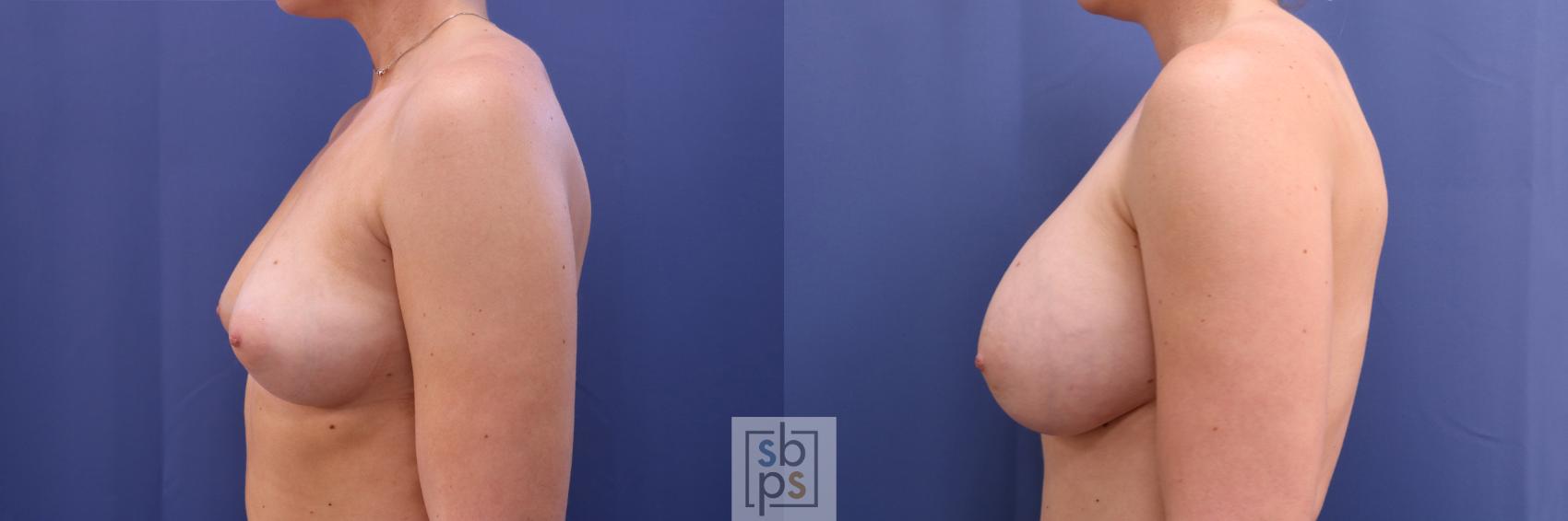 Before & After Breast Augmentation Case 327 View #2 View in Torrance & Los Angeles, CA, CA