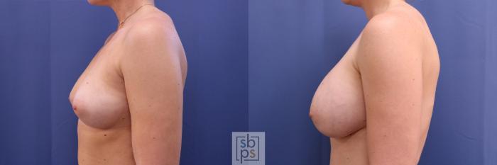Before & After Breast Augmentation Case 327 View #2 View in Torrance, CA