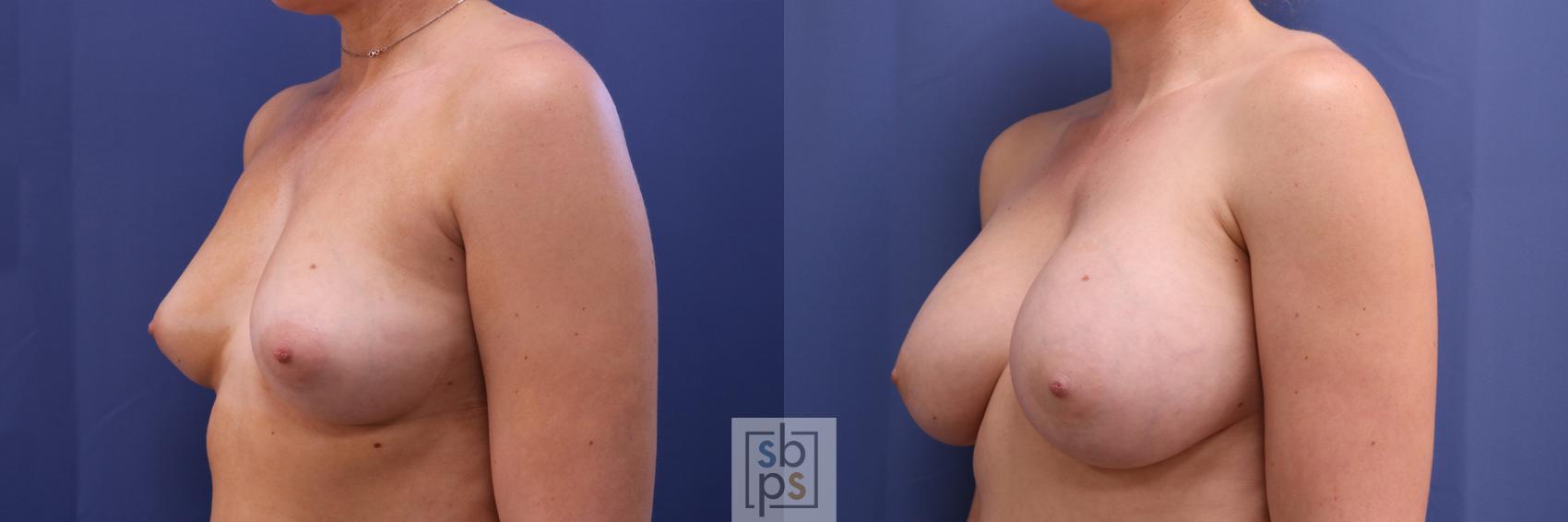 Before & After Breast Augmentation Case 327 View #3 View in Torrance & Los Angeles, CA, CA