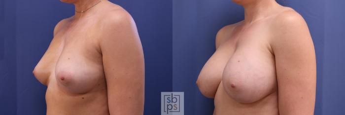 Before & After Breast Augmentation Case 327 View #3 View in Torrance, CA