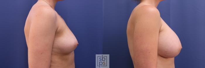 Before & After Breast Augmentation Case 327 View #4 View in Torrance, CA