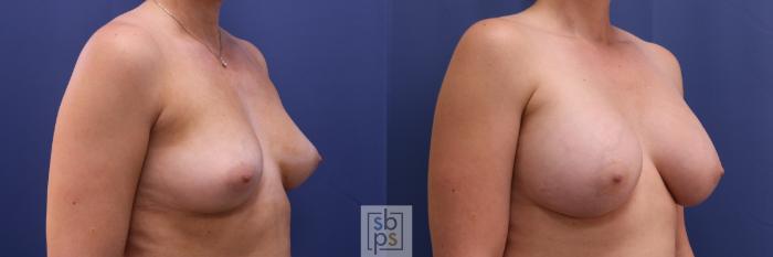 Before & After Breast Augmentation Case 327 View #5 View in Torrance, CA