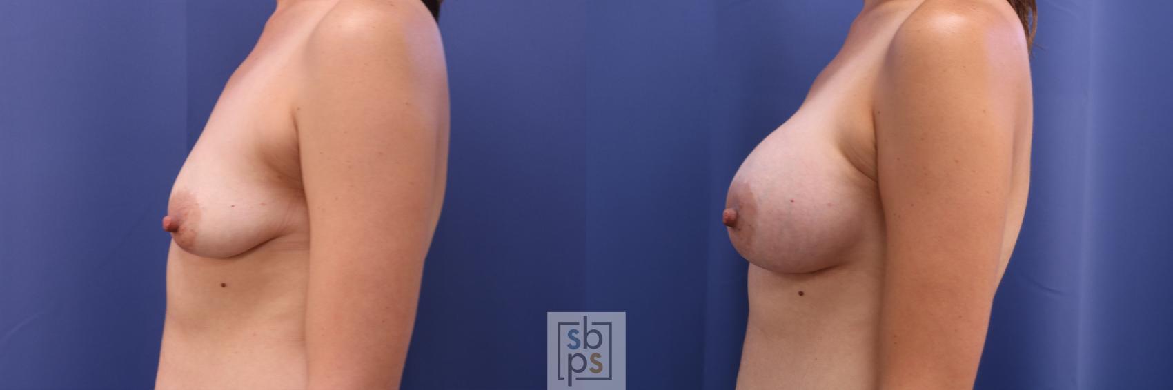Before & After Breast Augmentation Case 328 View #2 View in Torrance & Los Angeles, CA, CA