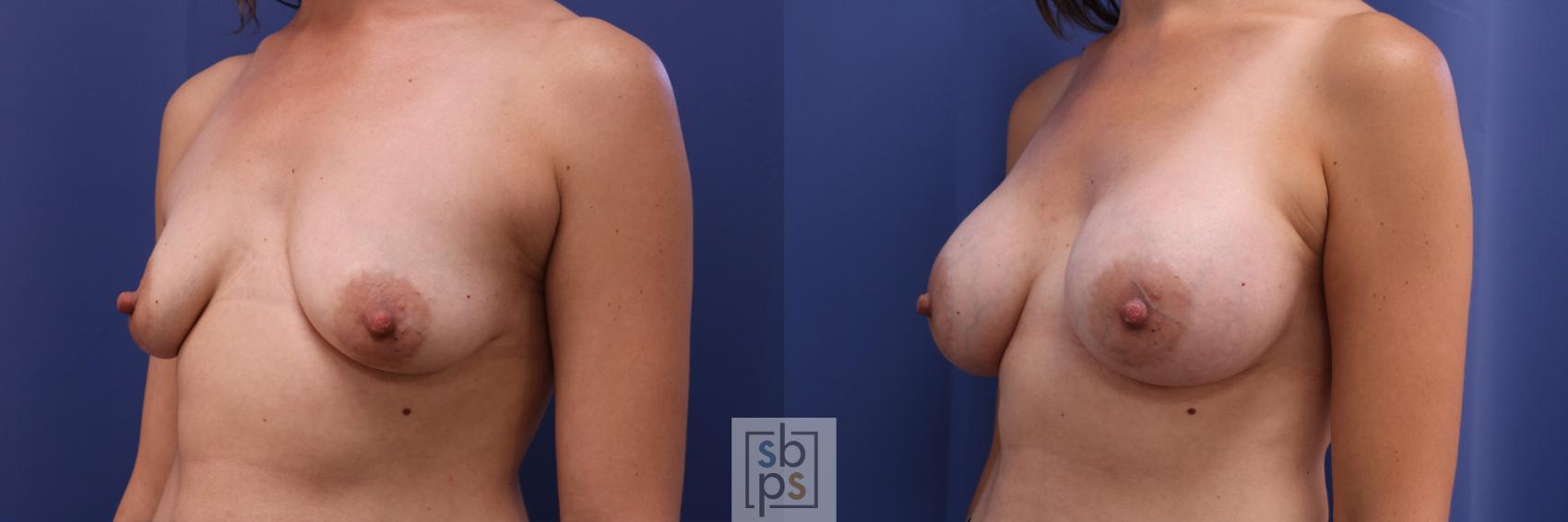 Before & After Breast Augmentation Case 328 View #3 View in Torrance & Los Angeles, CA, CA
