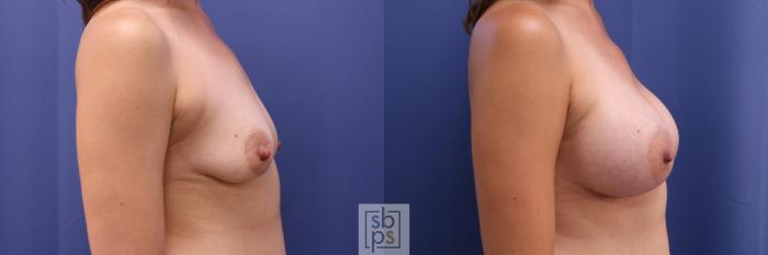Before & After Breast Augmentation Case 328 View #4 View in Torrance, CA