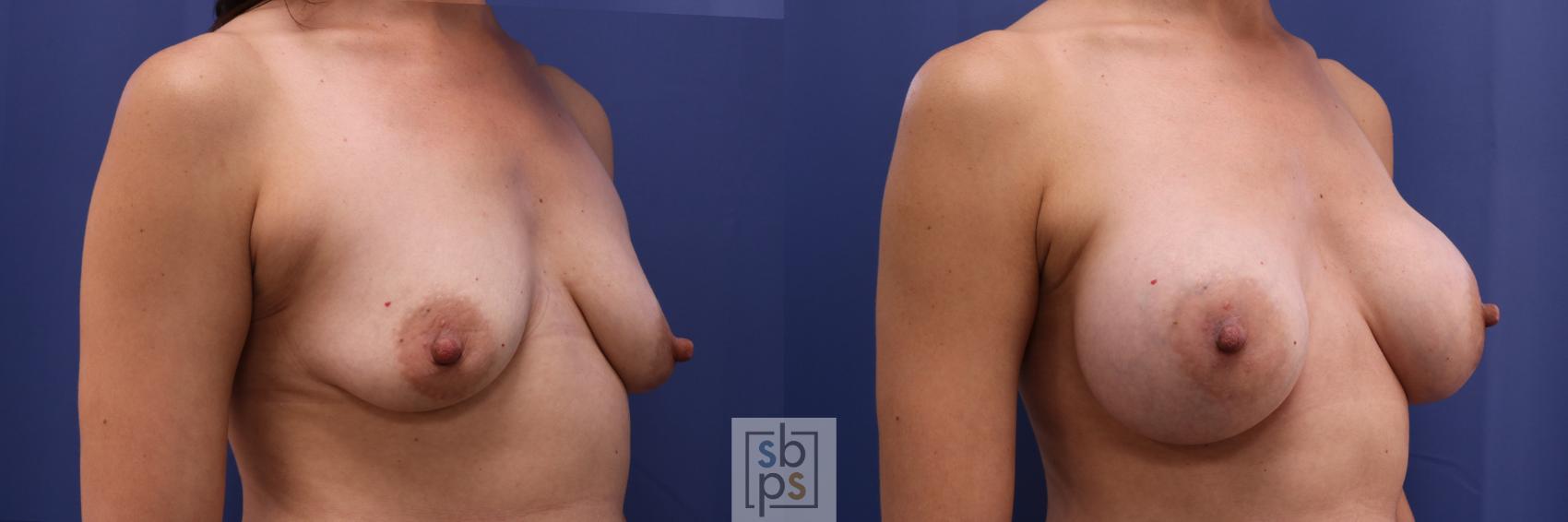 Before & After Breast Augmentation Case 328 View #5 View in Torrance & Los Angeles, CA, CA