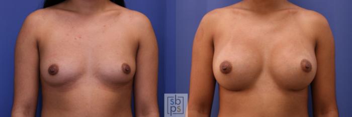 Before & After Breast Augmentation Case 329 View #1 View in Torrance, CA