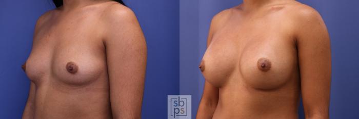 Before & After Breast Augmentation Case 329 View #3 View in Torrance, CA