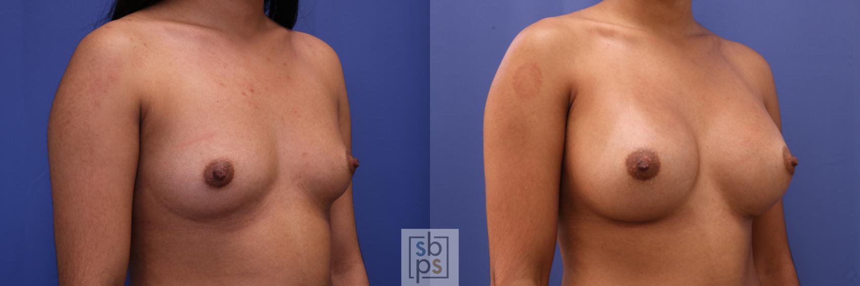 Before & After Breast Augmentation Case 329 View #5 View in Torrance & Los Angeles, CA, CA