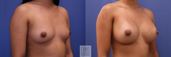 Before & After Breast Augmentation Case 329 View #5 View in Torrance, CA