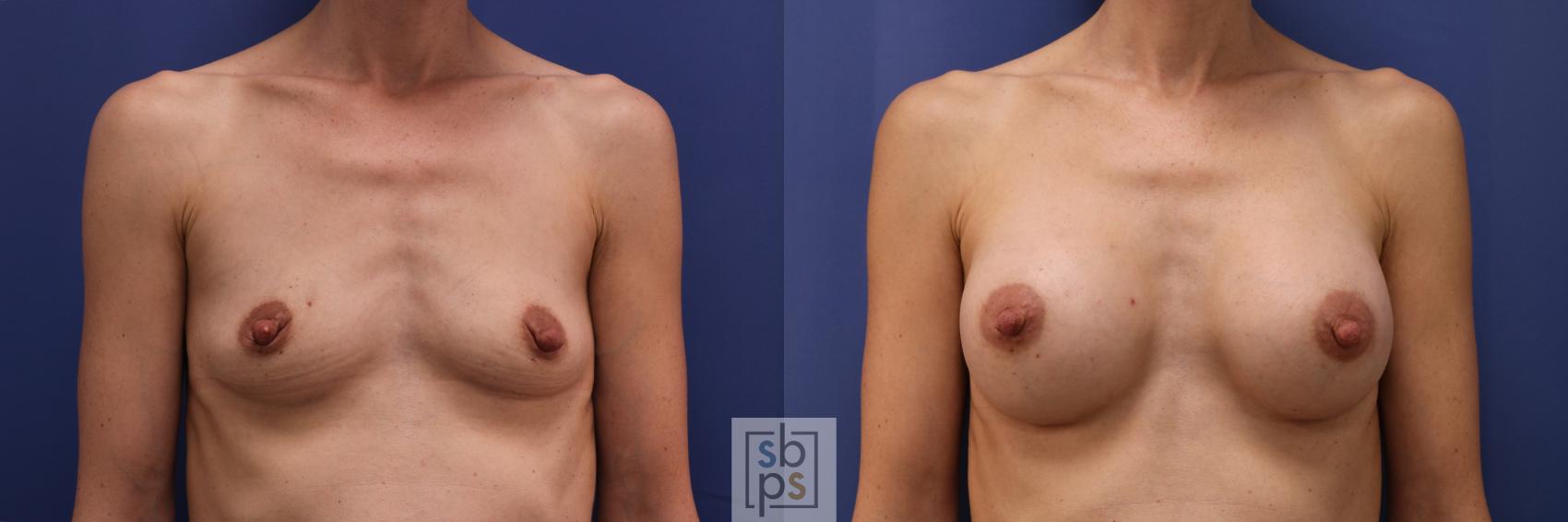 Before & After Breast Augmentation Case 330 View #1 View in Torrance, CA