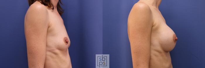Before & After Breast Augmentation Case 330 View #4 View in Torrance, CA