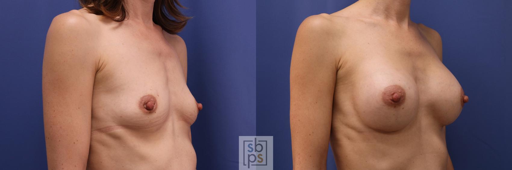 Before & After Breast Augmentation Case 330 View #5 View in Torrance & Los Angeles, CA, CA