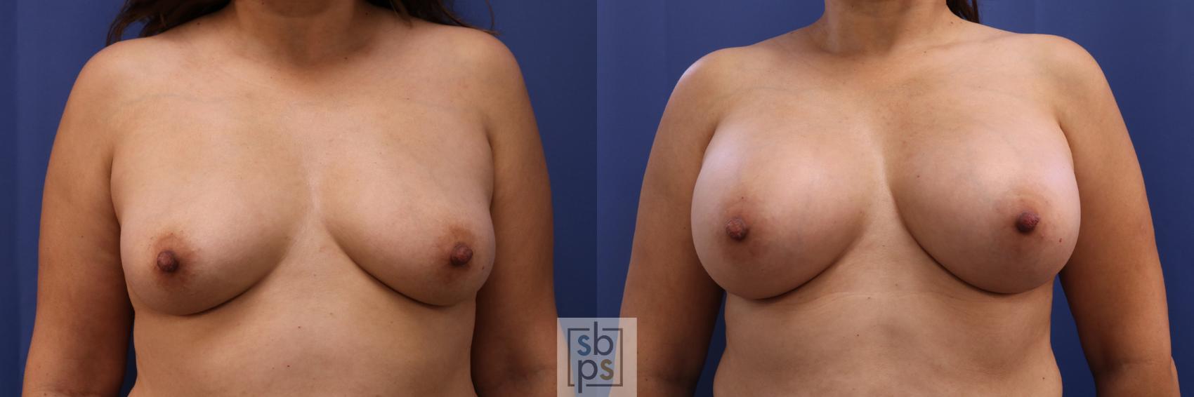 Before & After Breast Augmentation Case 331 View #1 View in Torrance, CA