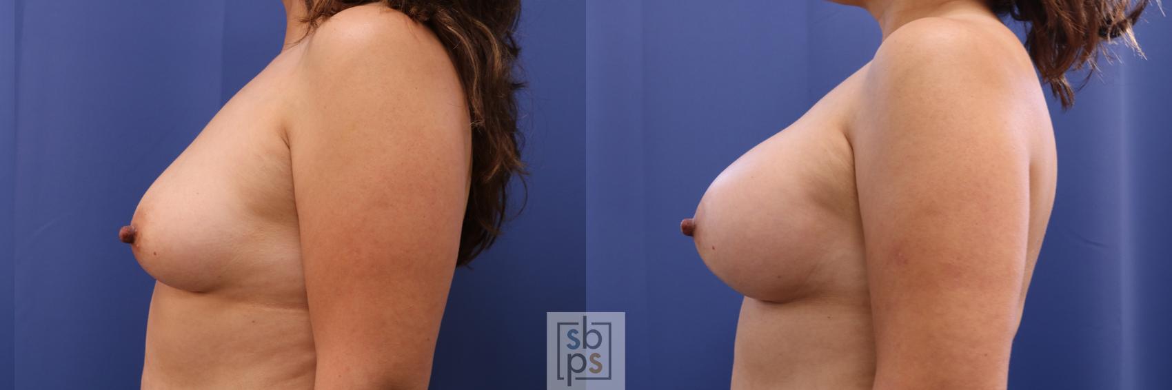 Before & After Breast Augmentation Case 331 View #2 View in Torrance & Los Angeles, CA, CA