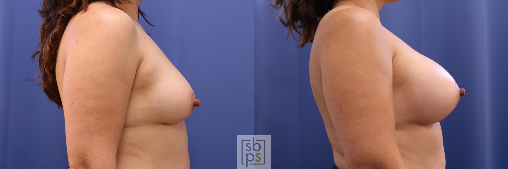 Before & After Breast Augmentation Case 331 View #4 View in Torrance & Los Angeles, CA, CA