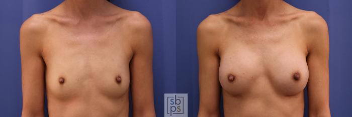 Before & After Breast Augmentation Case 332 View #1 View in Torrance, CA