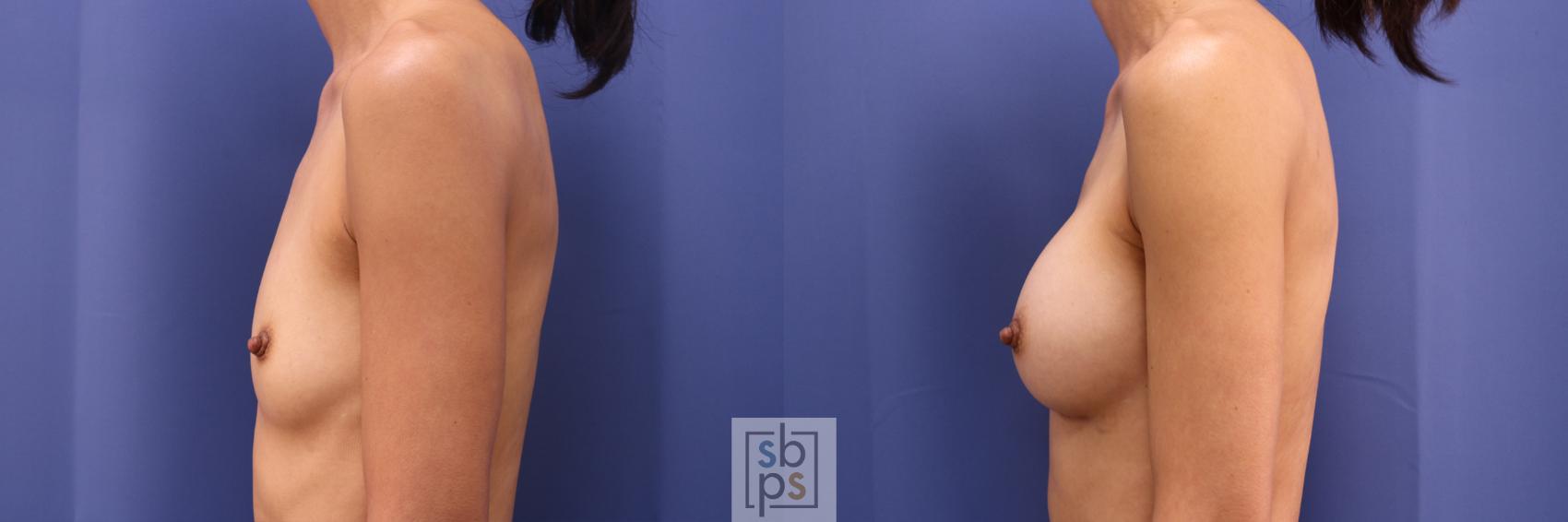 Before & After Breast Augmentation Case 332 View #2 View in Torrance & Los Angeles, CA, CA