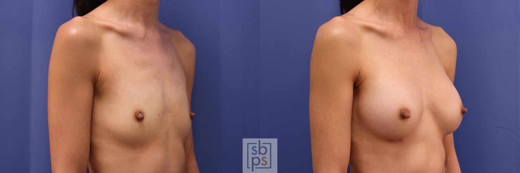 Before & After Breast Augmentation Case 332 View #5 View in Torrance & Los Angeles, CA, CA