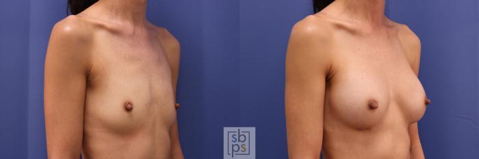 Before & After Breast Augmentation Case 332 View #5 View in Torrance, CA