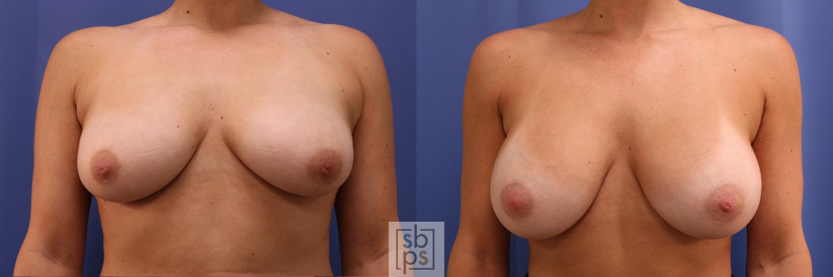 Before & After Breast Augmentation Case 333 View #1 View in Torrance, CA