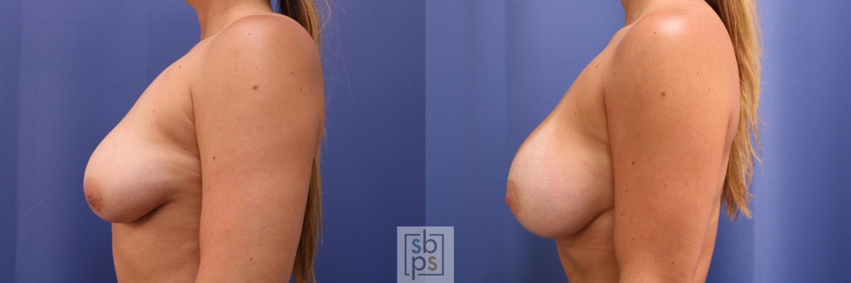 Before & After Breast Augmentation Case 333 View #2 View in Torrance & Los Angeles, CA, CA