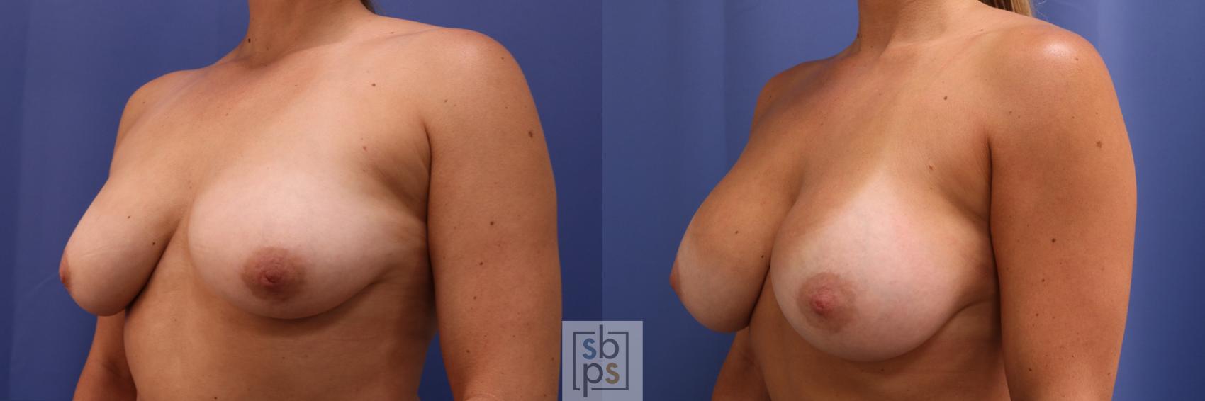 Before & After Breast Augmentation Case 333 View #3 View in Torrance & Los Angeles, CA, CA