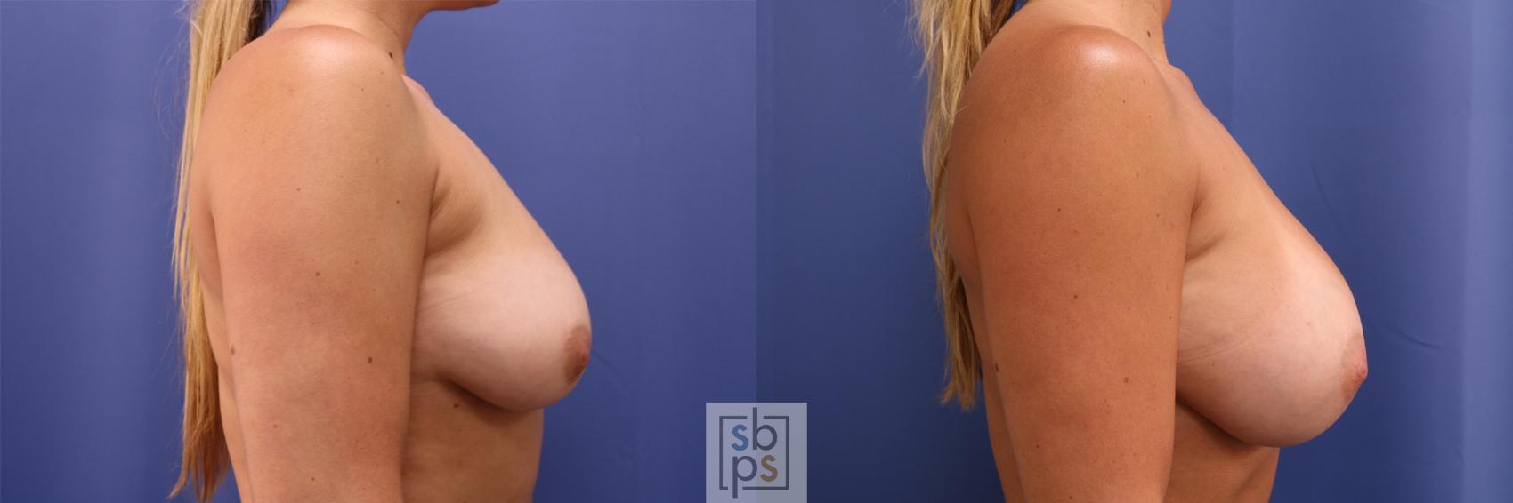 Before & After Breast Augmentation Case 333 View #4 View in Torrance & Los Angeles, CA, CA