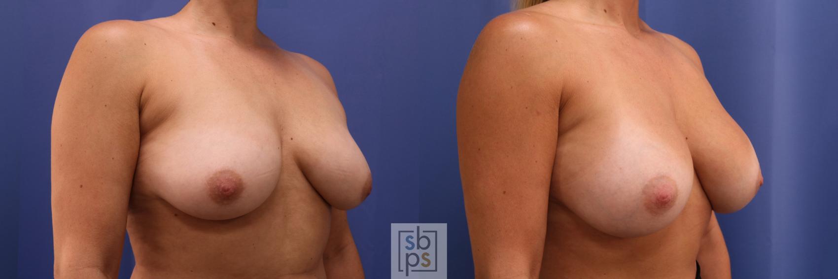 Before & After Breast Augmentation Case 333 View #5 View in Torrance & Los Angeles, CA, CA