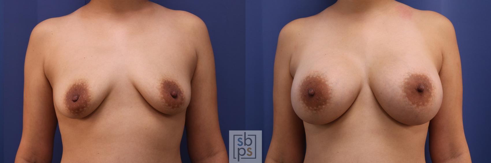 Before & After Breast Augmentation Case 334 View #1 View in Torrance, CA