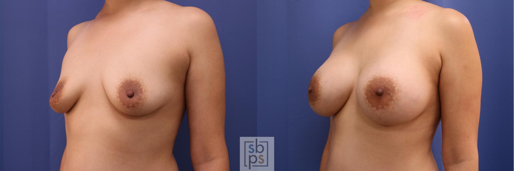 Before & After Breast Augmentation Case 334 View #3 View in Torrance & Los Angeles, CA, CA