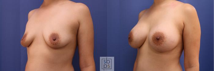 Before & After Breast Augmentation Case 334 View #3 View in Torrance, CA