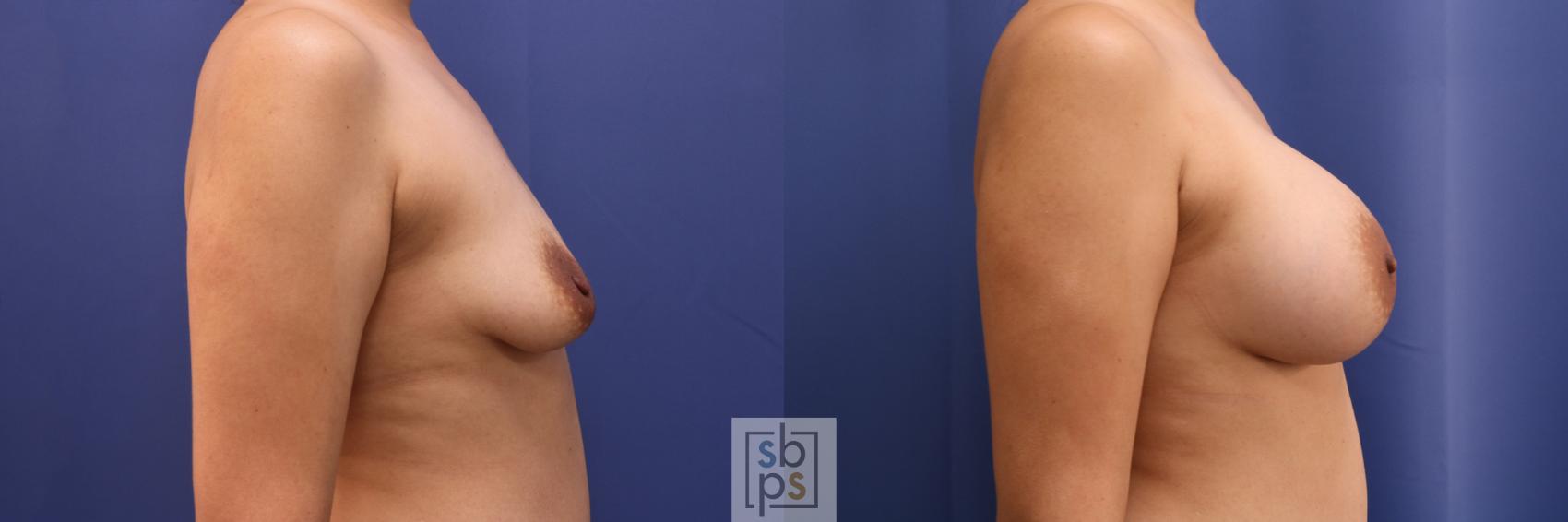 Before & After Breast Augmentation Case 334 View #4 View in Torrance & Los Angeles, CA, CA