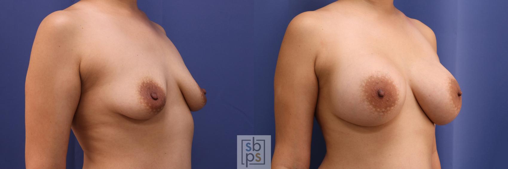 Before & After Breast Augmentation Case 334 View #5 View in Torrance & Los Angeles, CA, CA
