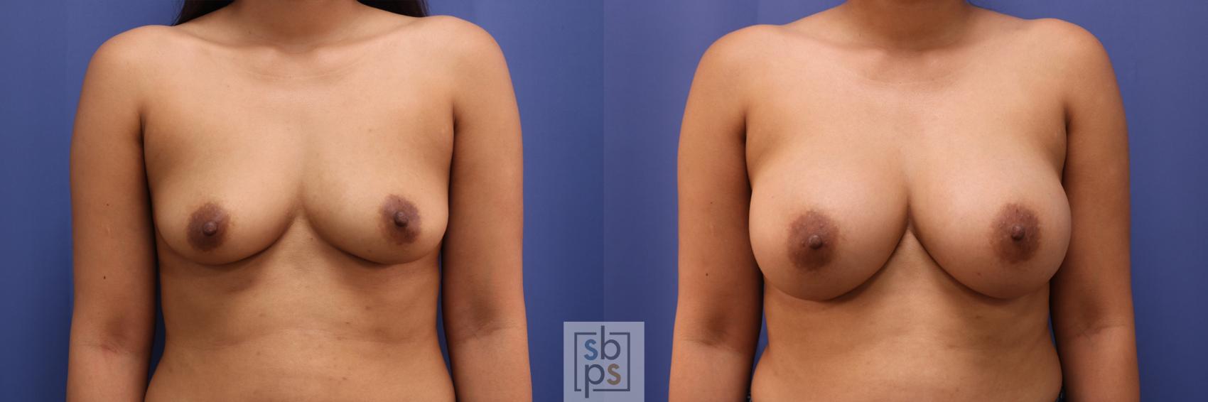 Before & After Breast Augmentation Case 335 View #1 View in Torrance, CA
