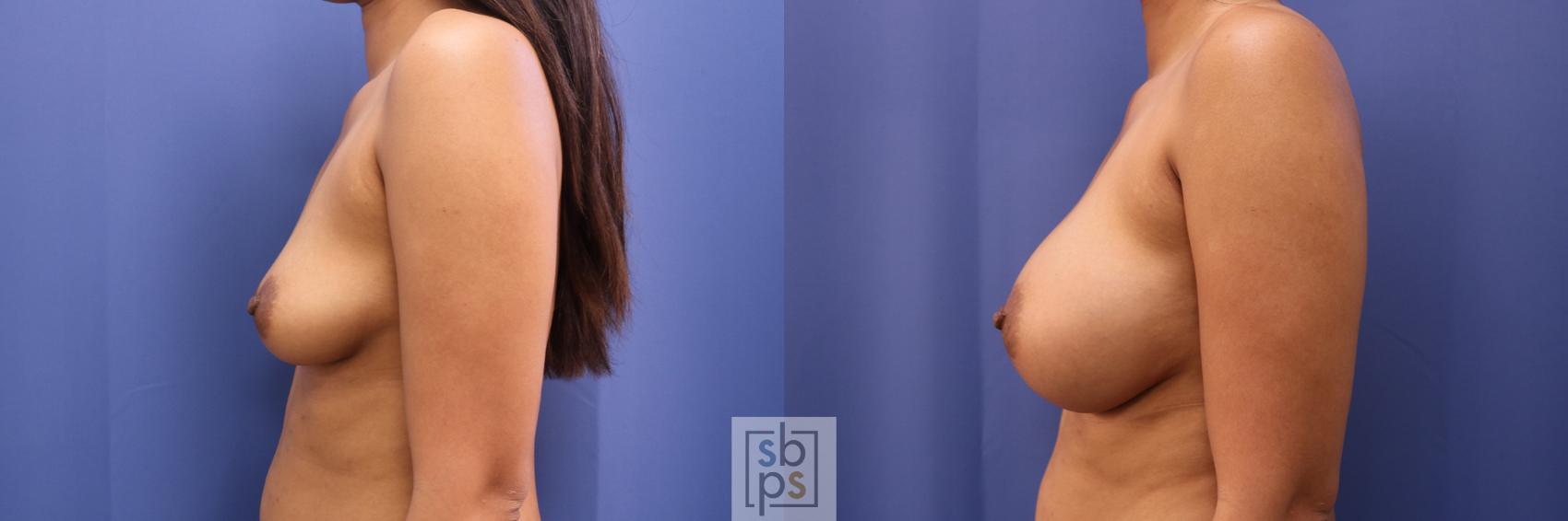 Before & After Breast Augmentation Case 335 View #2 View in Torrance & Los Angeles, CA, CA