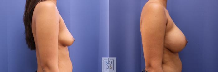 Before & After Breast Augmentation Case 335 View #4 View in Torrance, CA