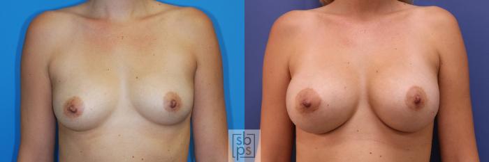 Before & After Breast Augmentation Case 349 View #1 View in Torrance, CA