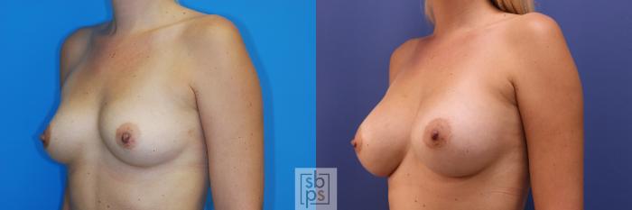 Before & After Breast Augmentation Case 349 View #3 View in Torrance, CA