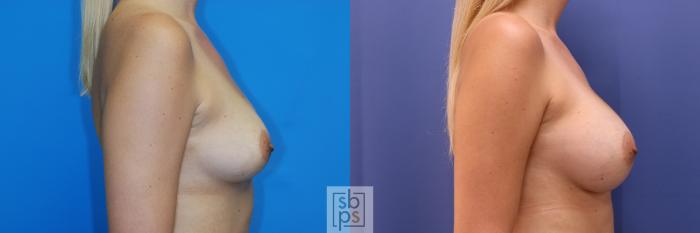 Before & After Breast Augmentation Case 349 View #4 View in Torrance, CA