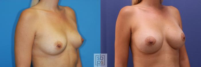Before & After Breast Augmentation Case 349 View #5 View in Torrance, CA
