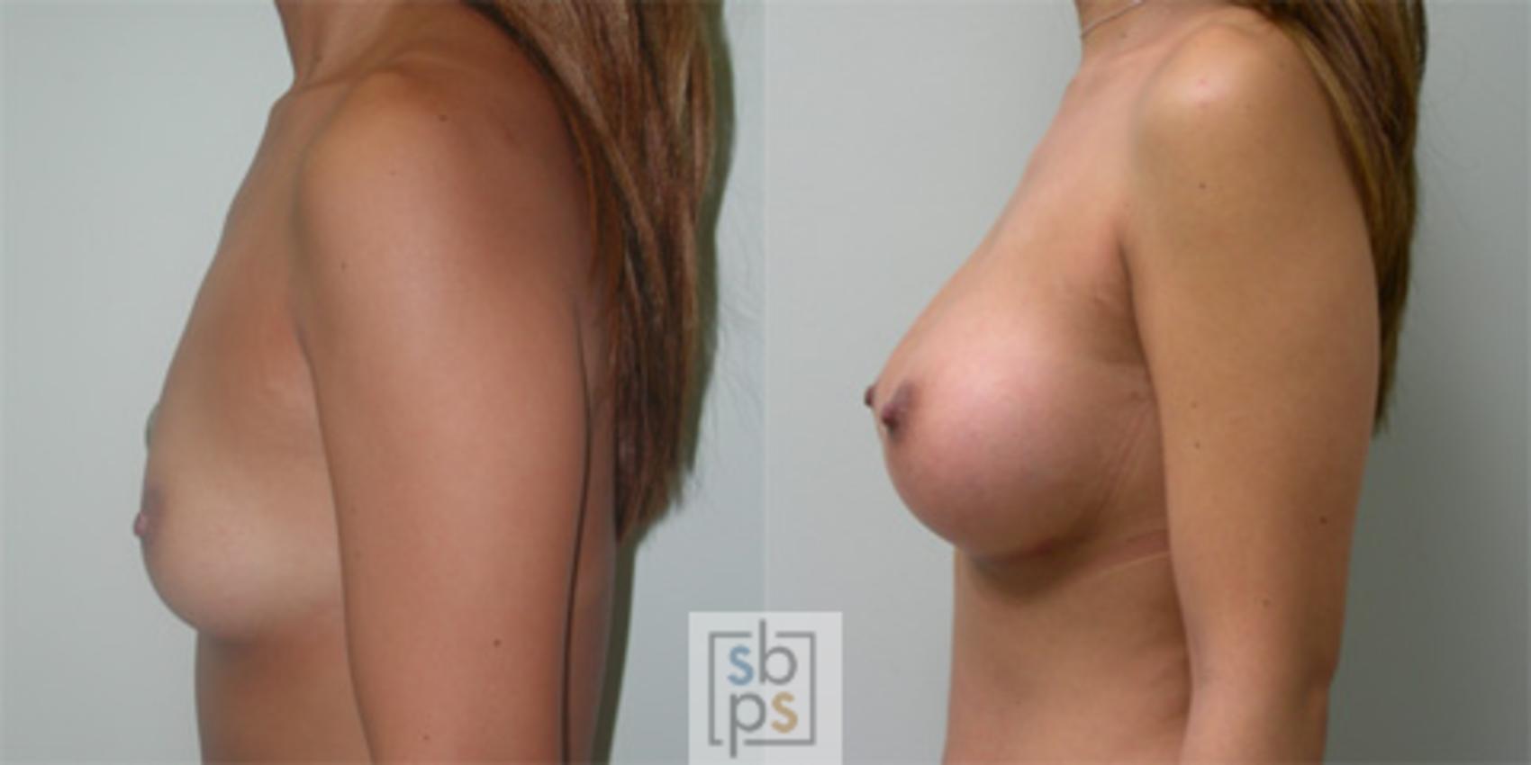 Before & After Breast Augmentation Case 35 View #1 View in Torrance, CA