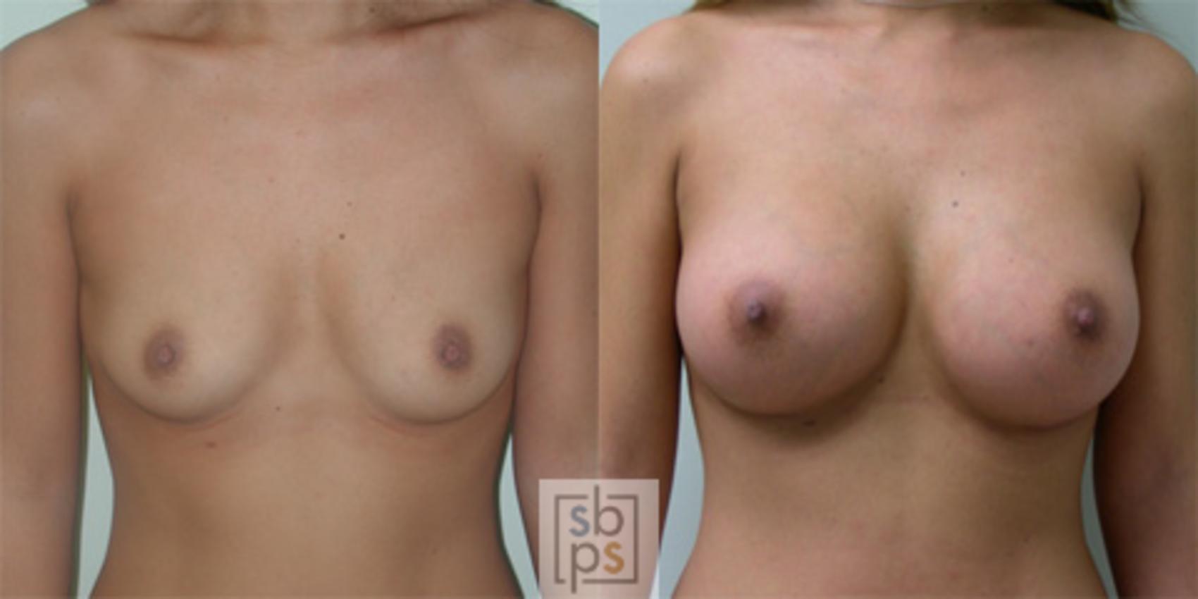 Before & After Breast Augmentation Case 35 View #2 View in Torrance & Los Angeles, CA, CA